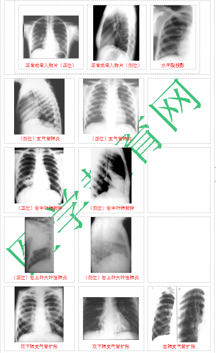 快收藏！臨床助理醫(yī)師實踐技能62個胸片（圖片診斷）