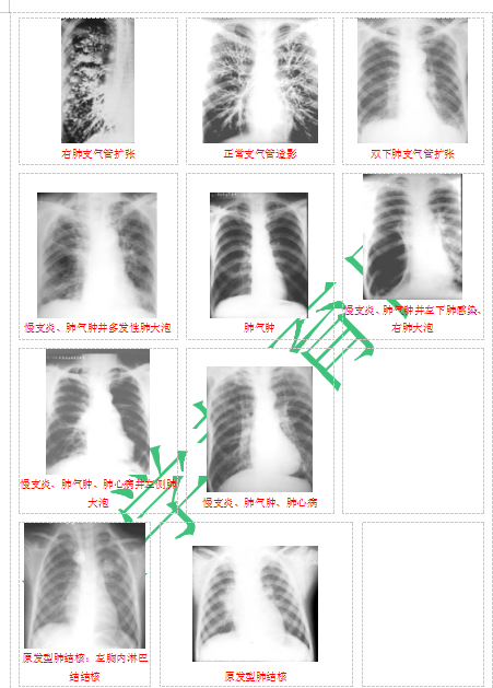 快收藏！臨床助理醫(yī)師實踐技能62個胸片（圖片診斷）